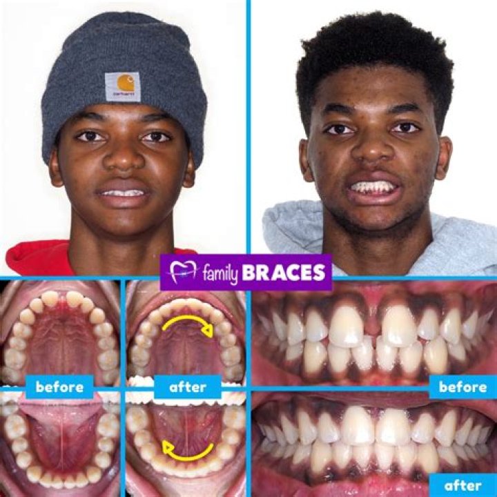 Has He Used Braces ·